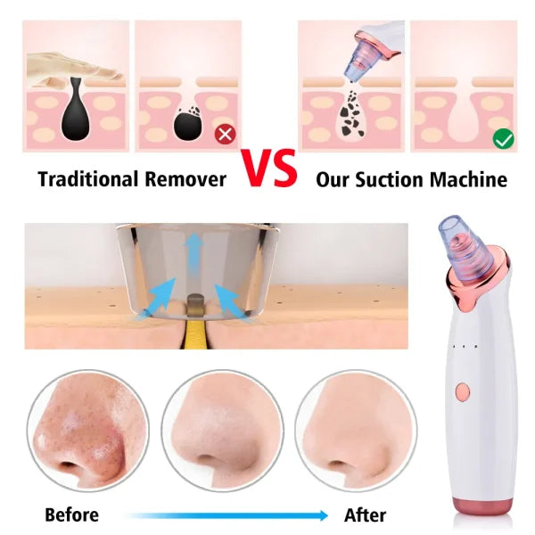 Blackhead Remover